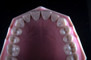 Root Canal Treatment