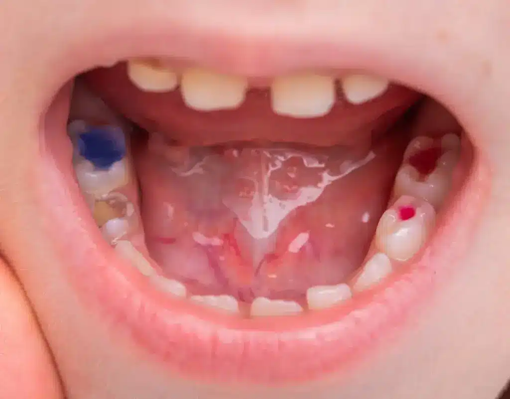 Childs Mouth with Colorful Dental Fillings 