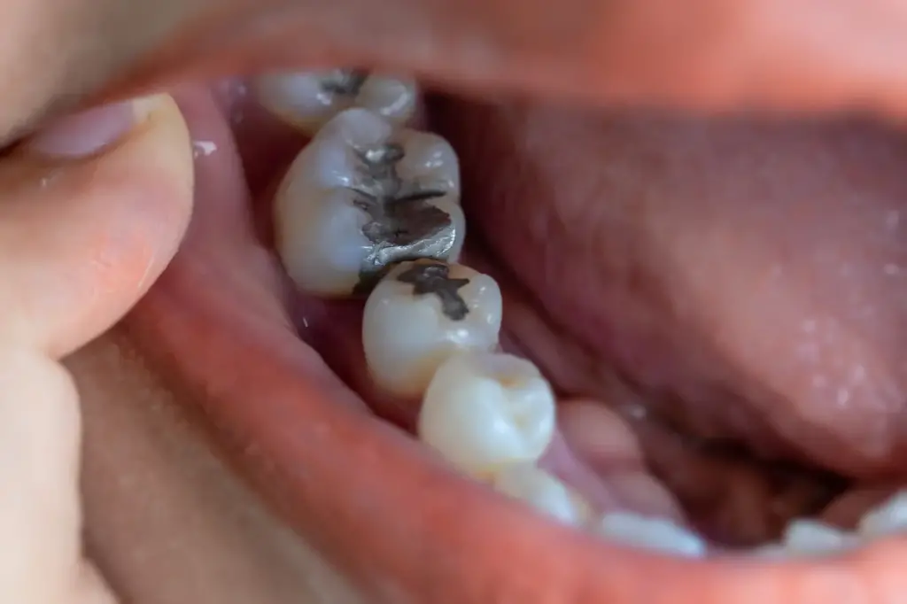 Dental Fillings 