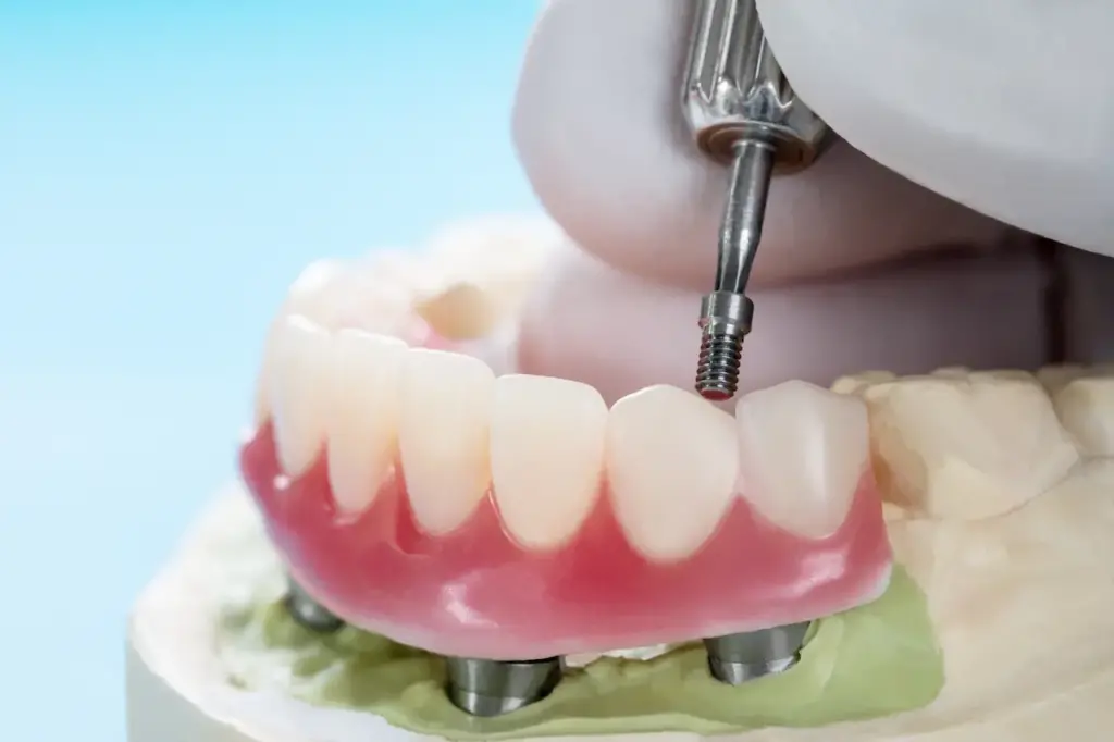 Dental Implants Supported Overdenture 