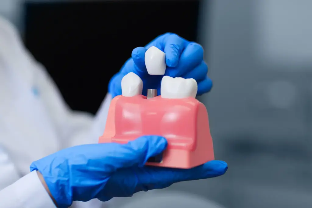 Model of Teeth with Dental Implants 
