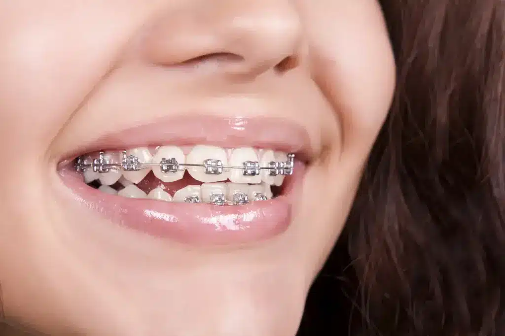The History Of Dental Braces