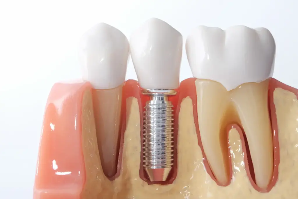 Generic Dental Teeth Model The History Of Dental Implants