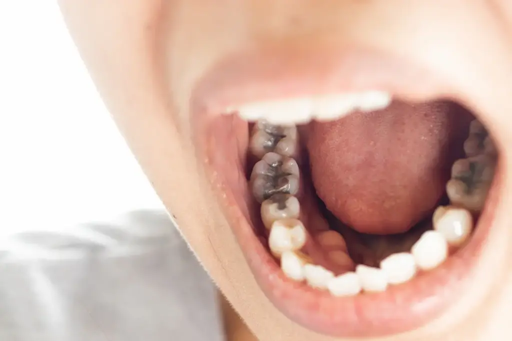 The History of Dental Fillings