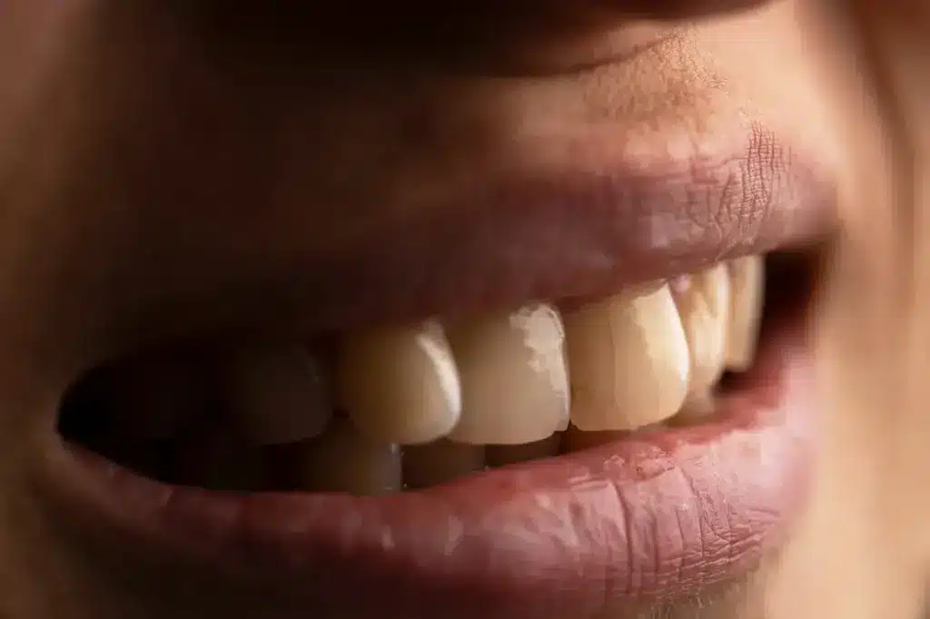 Cracked Teeth of a Woman 10 Common Dental Problems 