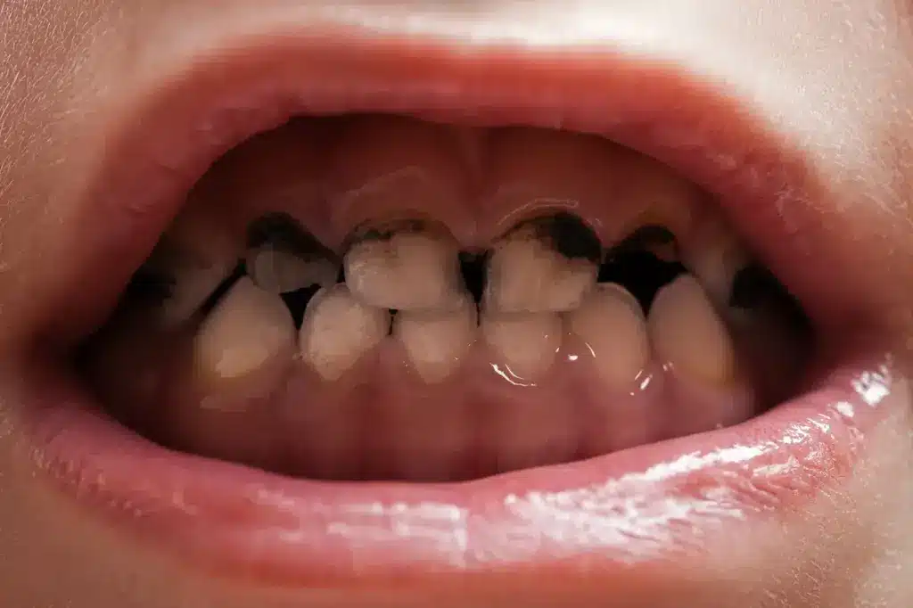 Kids Mouth with Decay