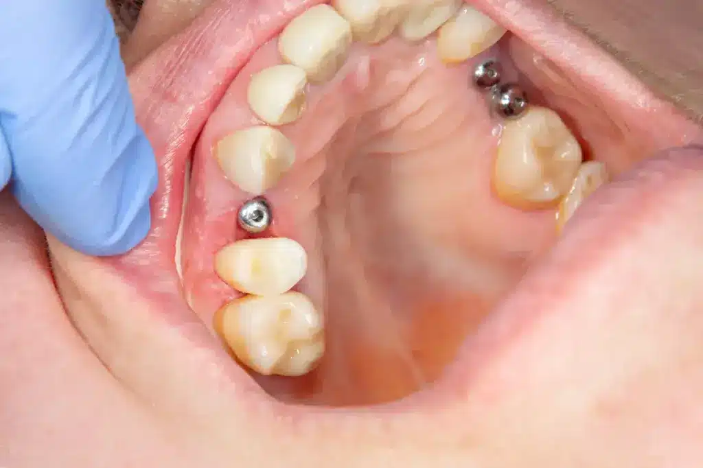 Mouth With Dental Implants 