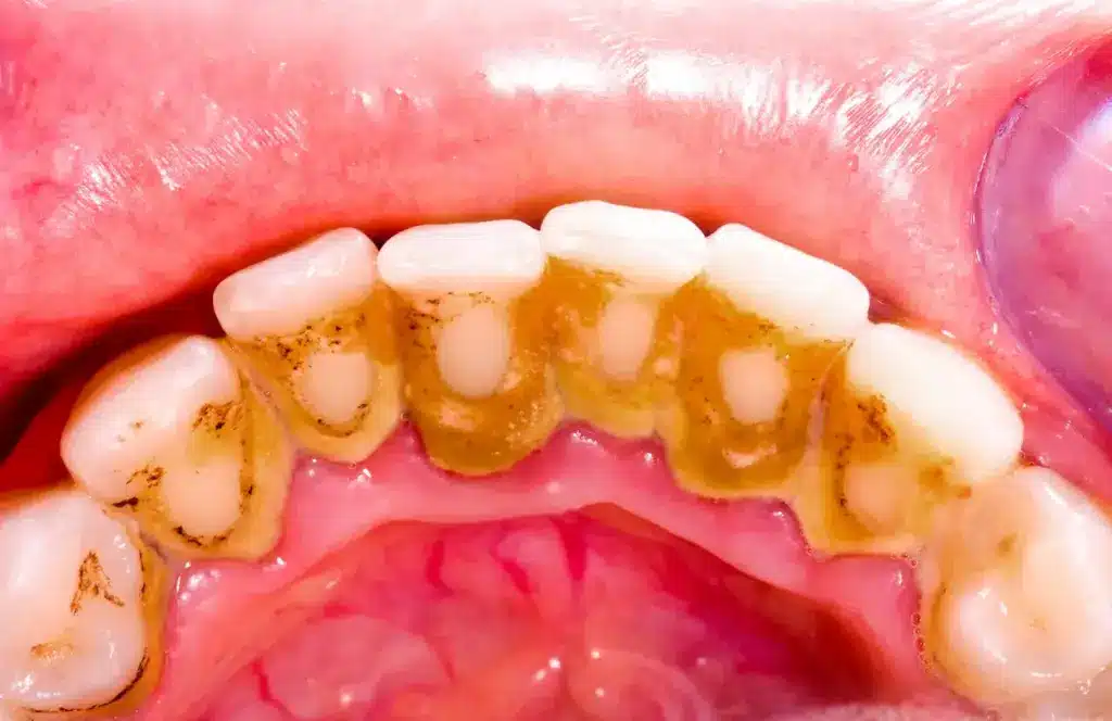 Plaque in Teeth