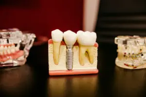 Seven Advantages of Dental Implants
