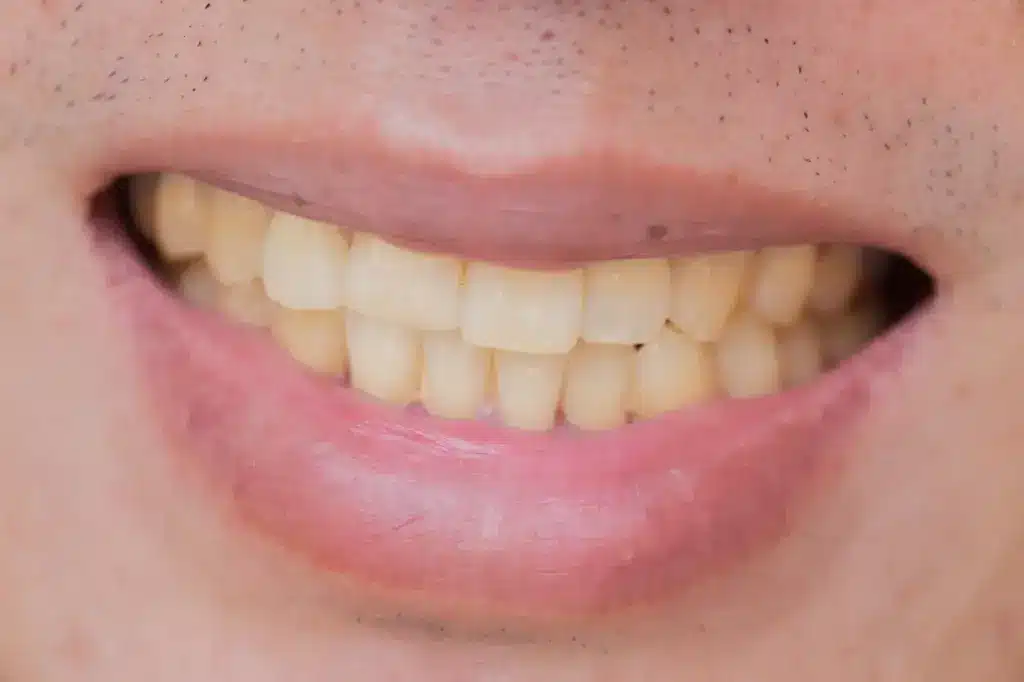 Yellow Teeth of a Man 